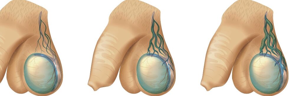 Cure de varicocèle micro-chirurgicale - Andrologie Paris